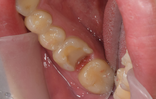 治療詳細画像｜【症例】自覚症状のない虫歯に対するセラミック（e-max）治療｜恵比寿デンタルクリニック東京