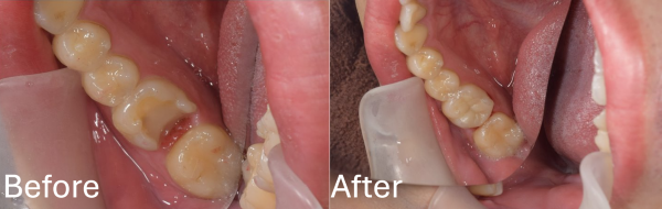 【症例】自覚症状のない虫歯に対するセラミック（e-max）治療