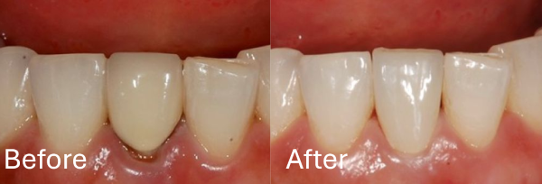 【症例】天然歯のような被せ物で前歯をやりかえ治療