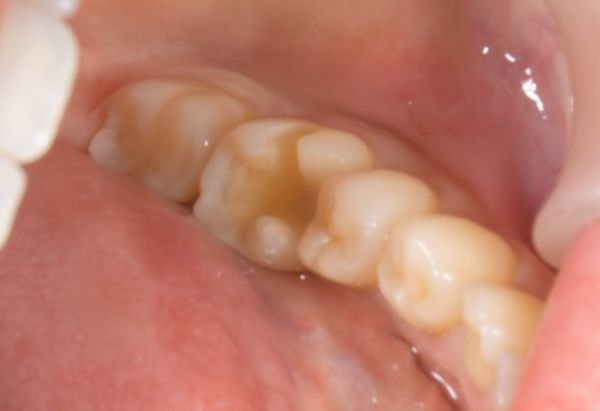 治療前画像｜【症例】虫歯に対してジルコニアインレー（Zenostar）で治療｜恵比寿デンタルクリニック東京