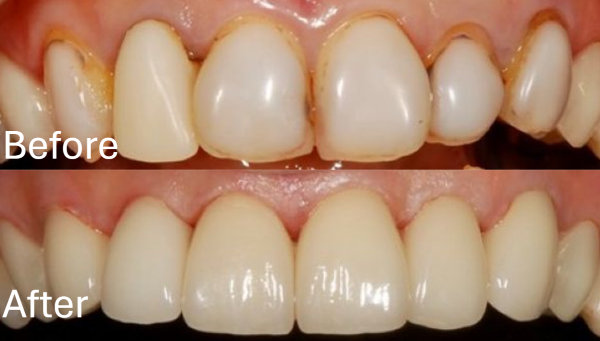 【症例】コンポジットレジンのラミネートをジルコニアセラミックで綺麗に修復