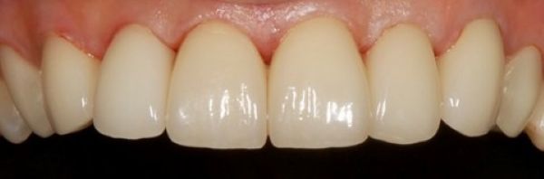 アフター画像|【症例】コンポジットレジンのラミネートをジルコニアセラミックで綺麗に修復|恵比寿デンタルクリニック東京