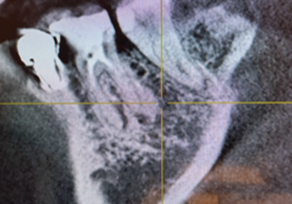 ビフォー画像 | 【症例】定期検診で発見した溶けてしまった奥歯に対する、エムドゲインを用いた骨再生治療 | 恵比寿デンタルクリニック東京