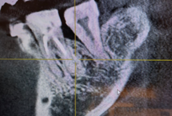 アフター画像 | 【症例】定期検診で発見した溶けてしまった奥歯に対する、エムドゲインを用いた骨再生治療 | 恵比寿デンタルクリニック東京