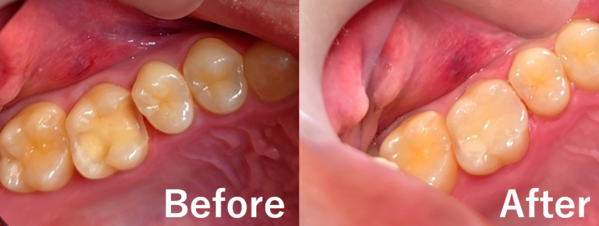 【症例】欠けてしみる奥歯をe-maxで審美的かつ機能的に改善