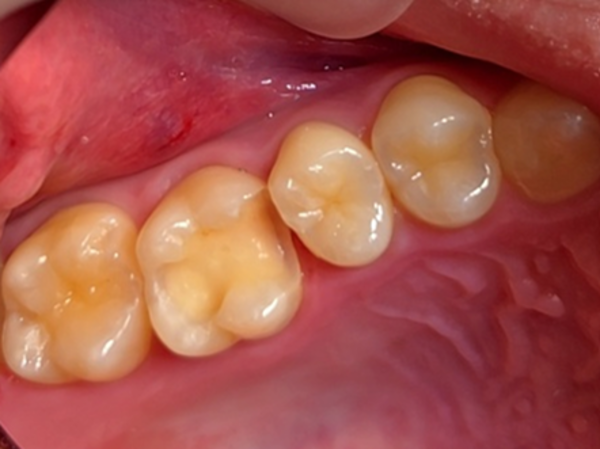 ビフォー画像 | 【症例】欠けてしみる奥歯をe-maxで審美的かつ機能的に改善 | 恵比寿デンタルクリニック東京