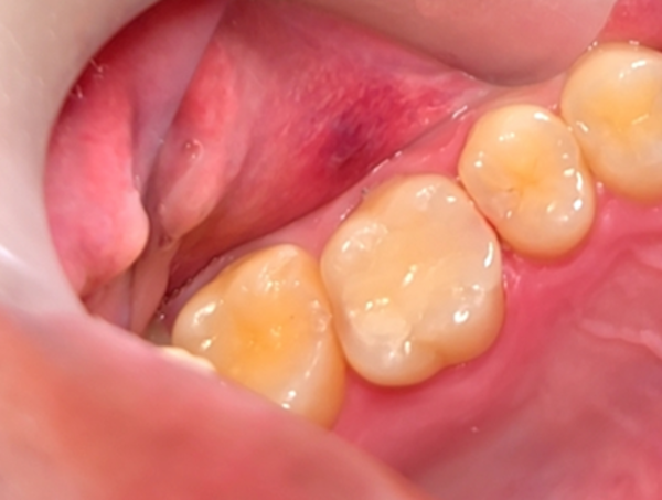 アフター画像 | 【症例】欠けてしみる奥歯をe-maxで審美的かつ機能的に改善 | 恵比寿デンタルクリニック東京