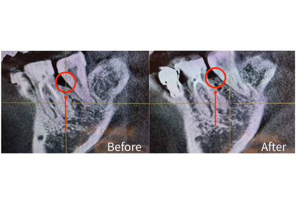 【症例】定期検診で発見した溶けてしまった奥歯に対する、エムドゲインを用いた骨再生治療