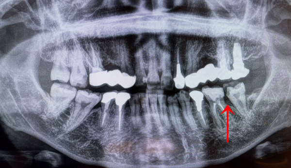 CT画像 | 【症例】定期検診で発見された奥歯の骨が溶けた症例に対し、エムドゲインを用いた骨再生治療 | 恵比寿デンタルクリニック東京
