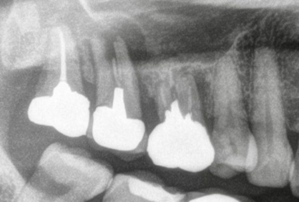 治療前画像 | 【症例】折れてしまった奥歯を抜歯し、サイナスリフトとインプラントで修復 | 恵比寿デンタルクリニック東京