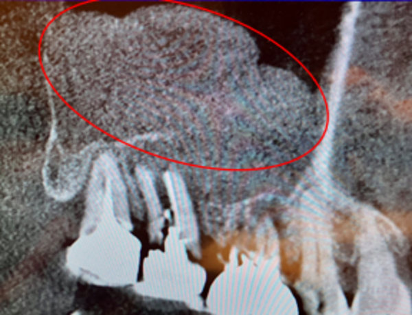 炎症時画像 | 【症例】折れてしまった奥歯を抜歯し、サイナスリフトとインプラントで修復 | 恵比寿デンタルクリニック東京