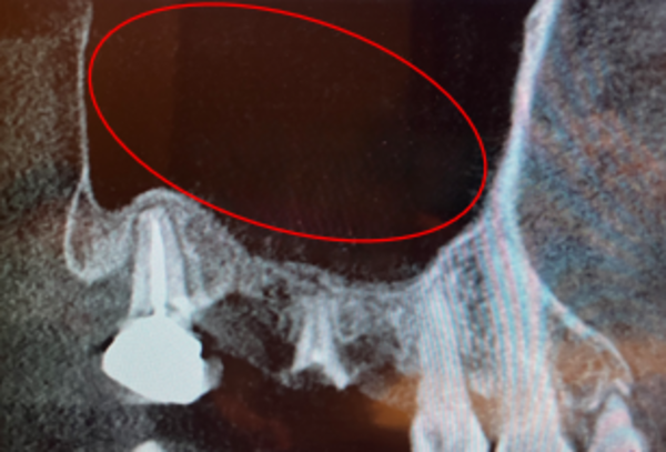 炎症後画像 | 【症例】折れてしまった奥歯を抜歯し、サイナスリフトとインプラントで修復 | 恵比寿デンタルクリニック東京