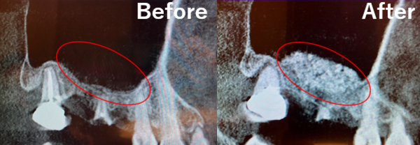 サイナスリフト　ビフォーアフター | 【症例】折れてしまった奥歯を抜歯し、サイナスリフトとインプラントで修復 | 恵比寿デンタルクリニック東京