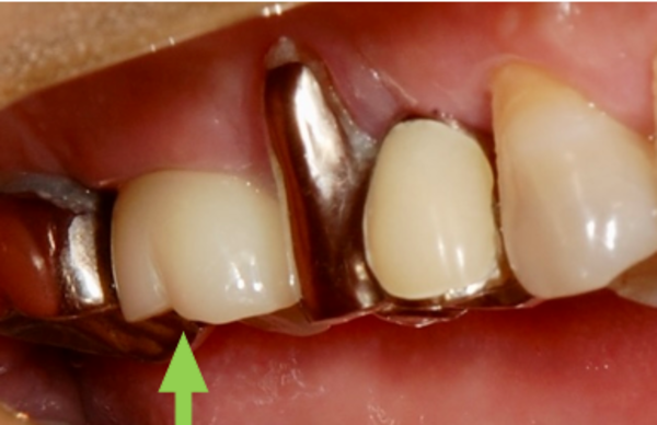 治療後画像 | 【症例】折れてしまった奥歯を抜歯し、サイナスリフトとインプラントで修復 | 恵比寿デンタルクリニック東京
