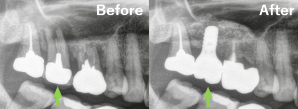 【症例】折れてしまった奥歯を抜歯し、サイナスリフトとインプラントで修復