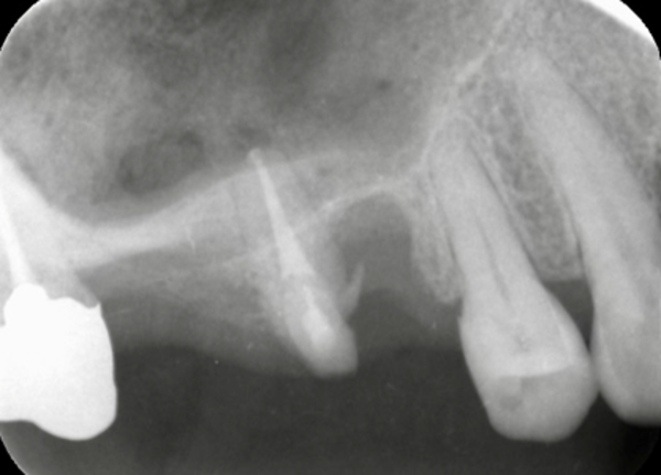 根幹治療後 | 【症例】折れてしまった奥歯を抜歯し、サイナスリフトとインプラントで修復 | 恵比寿デンタルクリニック東京