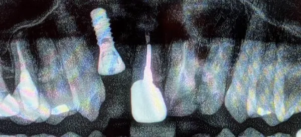 レントゲン画像 |【症例】問題のある噛み合わせをジルコニアセラミックによる補綴治療で良好な状態へ|恵比寿デンタルクリニック東京